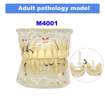 Zubné Patológia Zuby Model Dospelých Implantát/Deti Carious Cysty Pre Zubného Lekárstva Učiť Demo Vedy Ochorenia